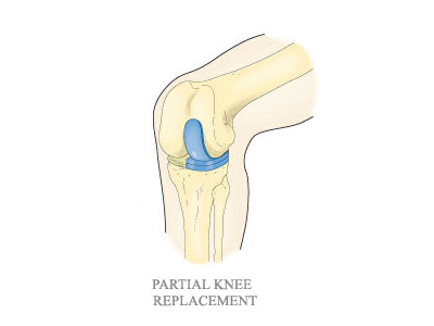 partial knee replacement surgery