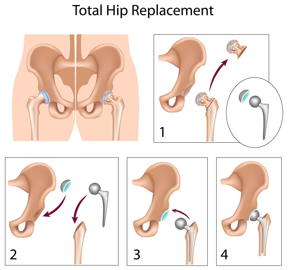 Total Hip replacement Surgeon